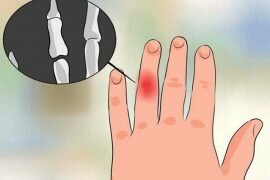 Отбитый палец на руке лечение