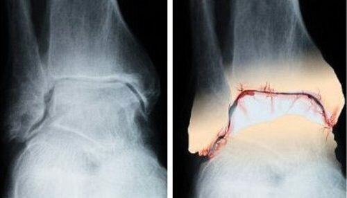 Деформирующий артроз голеностопного сустава на рентгене