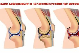 Артроз левого коленного сустава мази