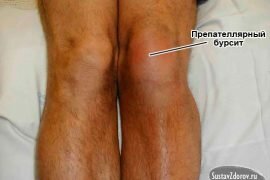 Реактивный бурсит коленного сустава
