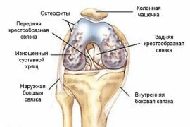 Лечение артрита коленного сустава медикаментозное лечение