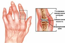 Воспаление суставов рук при переохлаждении