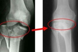 Инъекции для восстановления хряща при артрозе коленного сустава