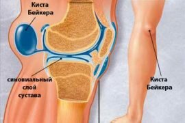 Удаление кисты бейкера коленного сустава