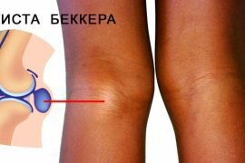 Народные методы лечения остеоартроза коленного сустава