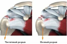 Что такое артрит плеча
