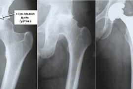 Реабилитация после эндопротезирования коленного сустава по бубновскому