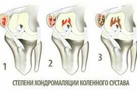 Классификация переломов коленного сустава